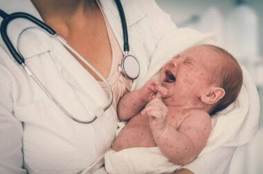 Más de 50 niños hospitalizados por sarampión en Birmingham