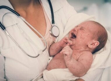 Más de 50 niños hospitalizados por sarampión en Birmingham