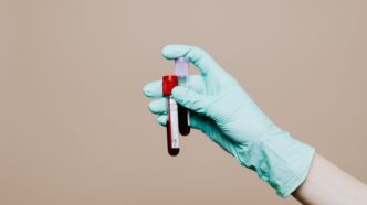 Descifran el mensaje oculto del ADN en sangre que predice el regreso del cáncer más letal de piel