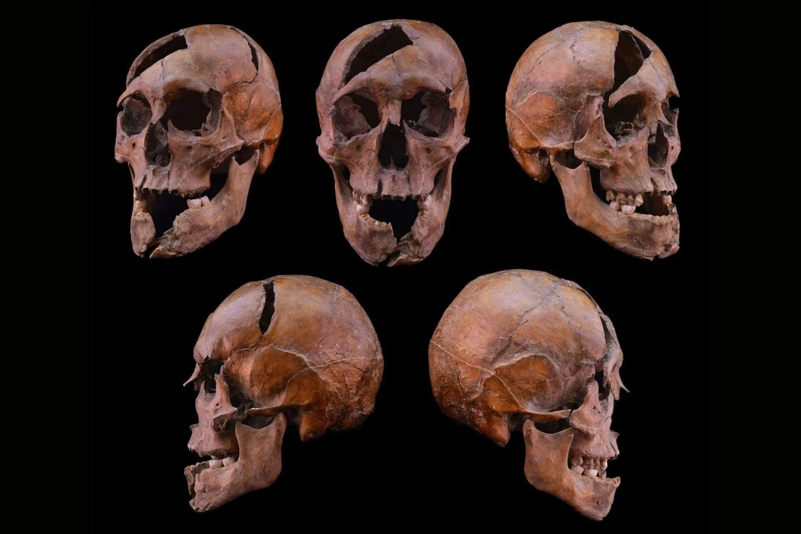 El cráneo del individuo analizado, hallado en el antiguo monasterio dominico del siglo XIII en la Isla Margarita de Budapest